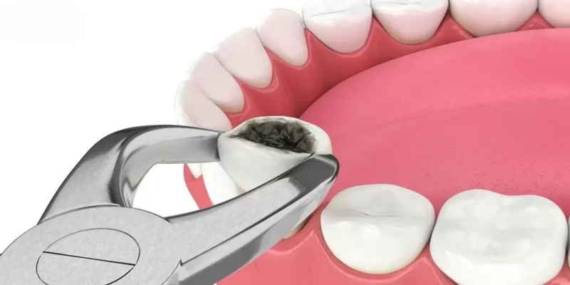 Nằm mơ thấy nhổ răng hàm dưới là điềm gì?